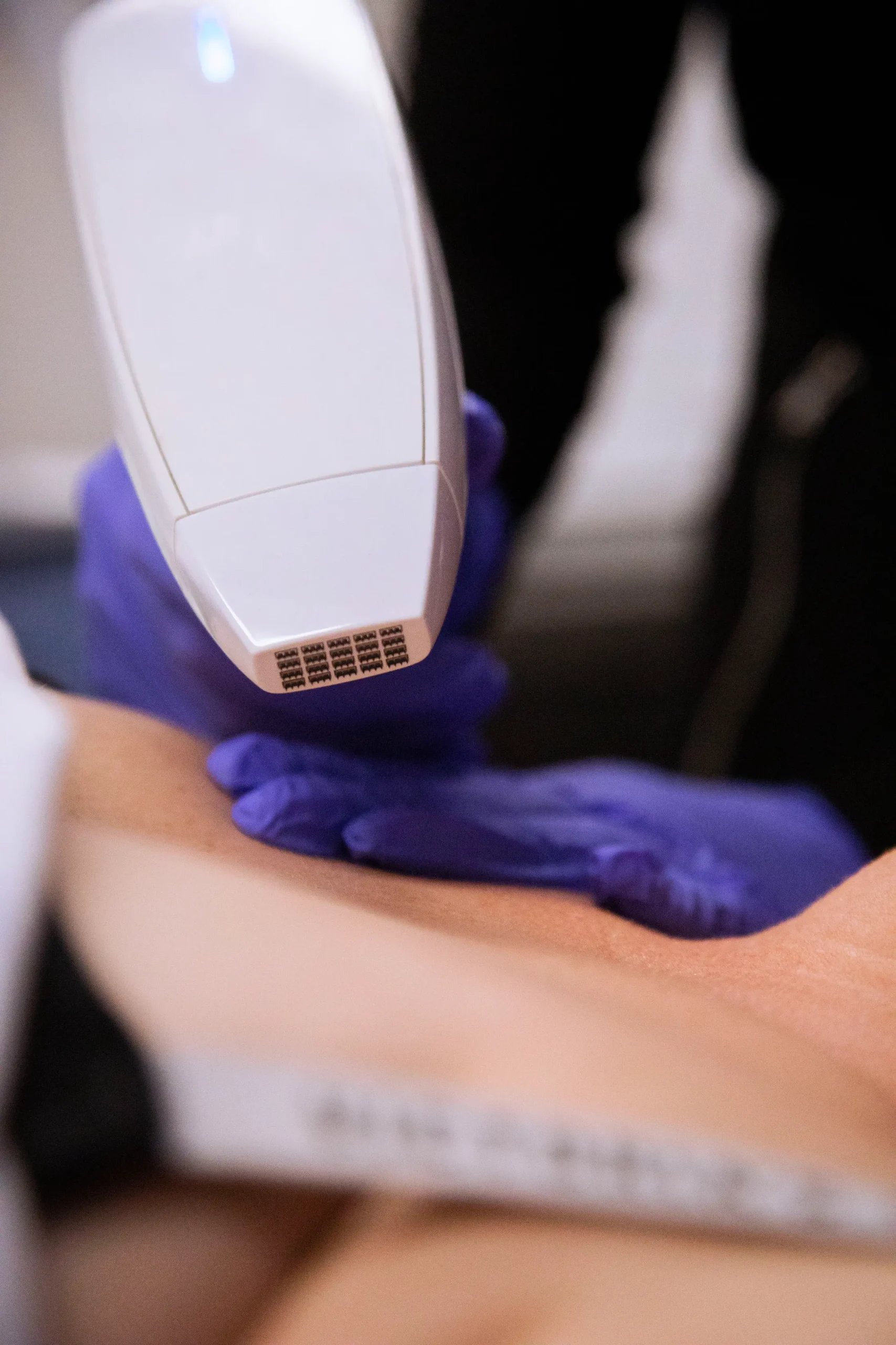 Viva Laser Page Viva laser skin resurfacing treatment at Vytality Wellness & Medical Aesthetics in Maple Grove